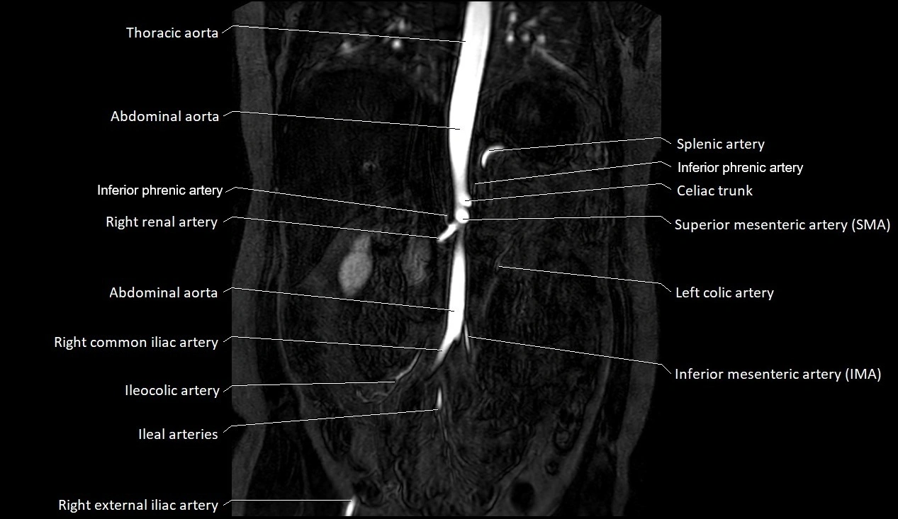 MRA Abdomen coronal anatomy image 18.webp